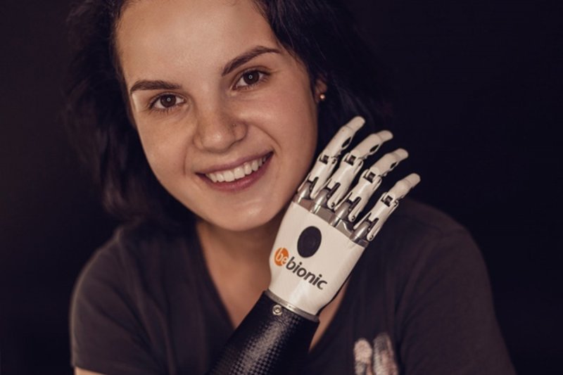 Девушка с отрубленными руками получила новый бионический протез