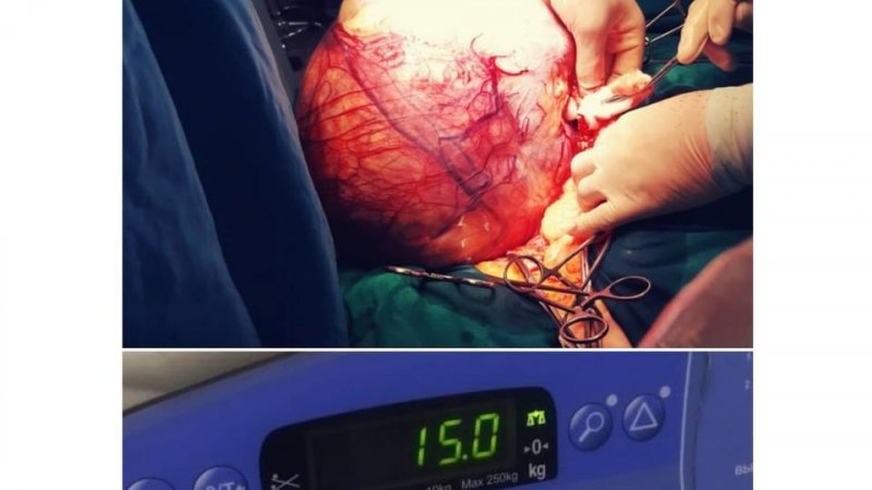 Жительнице Подмосковья удалили 15-килограммовую опухоль 