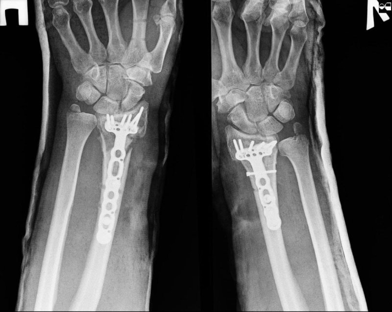 Врачи в Ступино восстановили кисти мужчине с измененной анатомией обеих рук