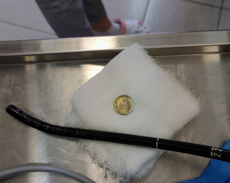 Подмосковные врачи без операции извлекли монету из пищевода ребенка