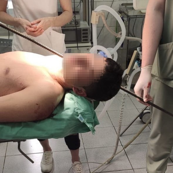 Врачи Пушкинской больницы удалили мужчине из шеи 1,5-метровую арматуру