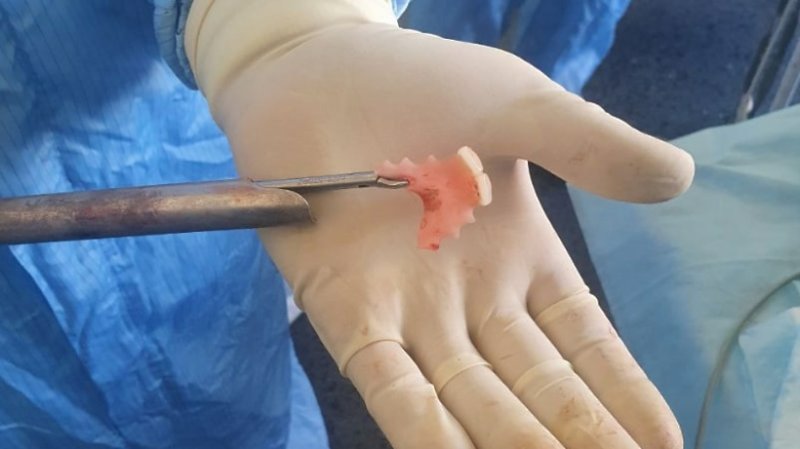 Врачи Сергиево-Посадской больницы спасли 24-летнего мужчину, проглотившего зубной протез