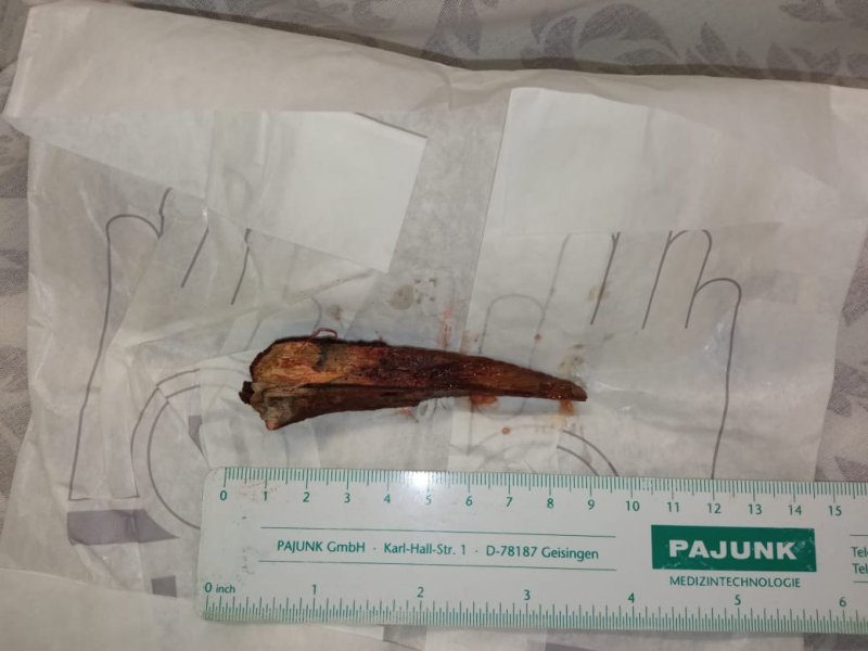 Подмосковные врачи спасли ребёнка, проткнувшего локоть 9-ти сантиметровым суком