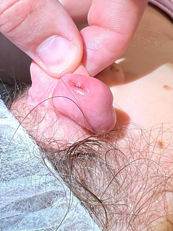 В Раменском врачи удалили опухоль на ухе, появившуюся у ребенка после укуса собаки