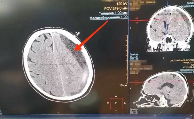Пушкинские врачи спасли жизнь мужчине, удалив внутричерепную гематому