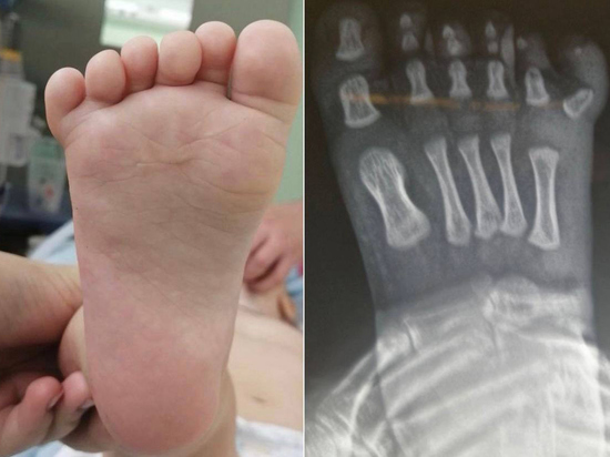 Подмосковные хирурги удалили шестой палец  маленькому ребенку