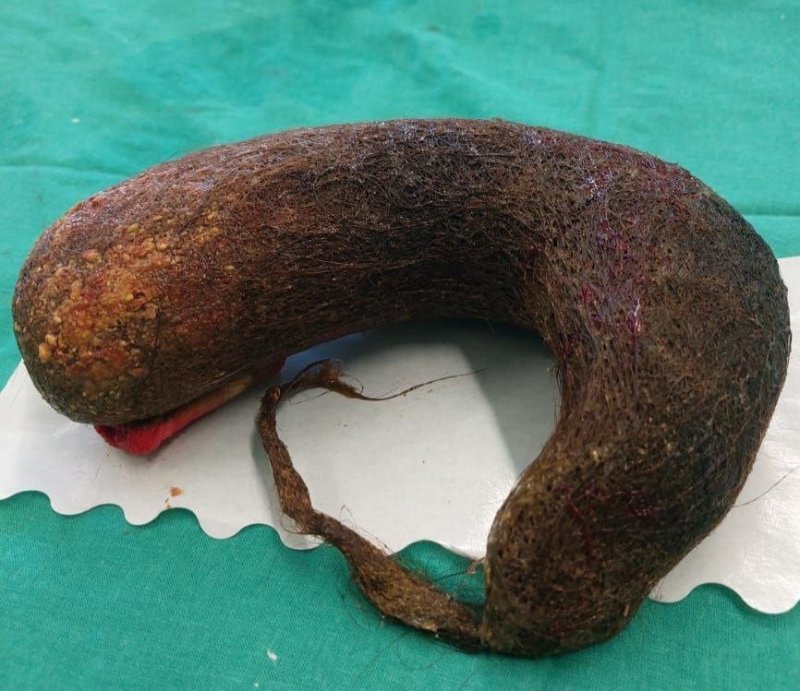 В Раменской больнице пациентке удалили 45-сантиметровый волосяной комок весом около одного килограмма