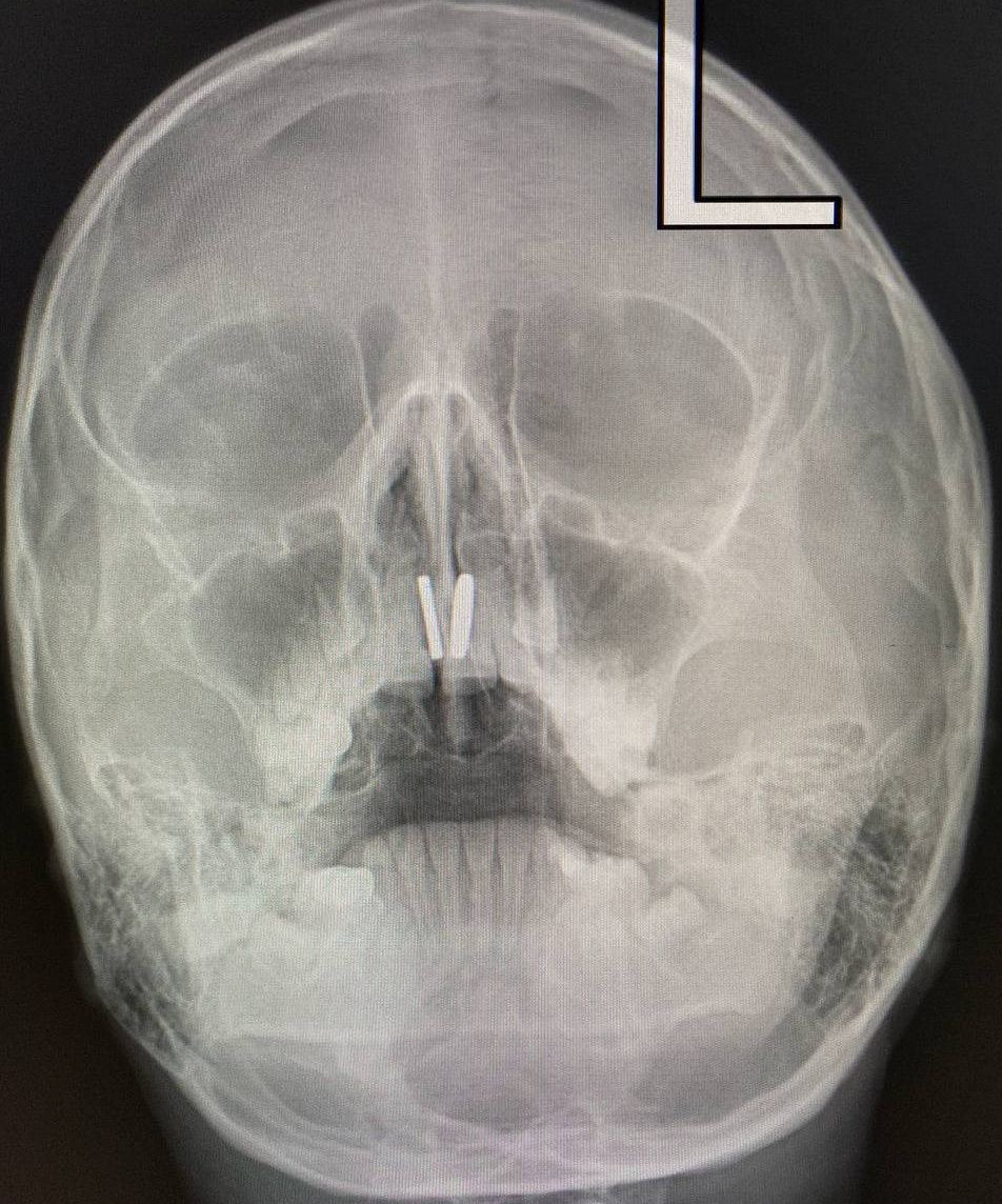 В Пушкине врачи извлекли два магнита из носа 8-летнего ребёнка