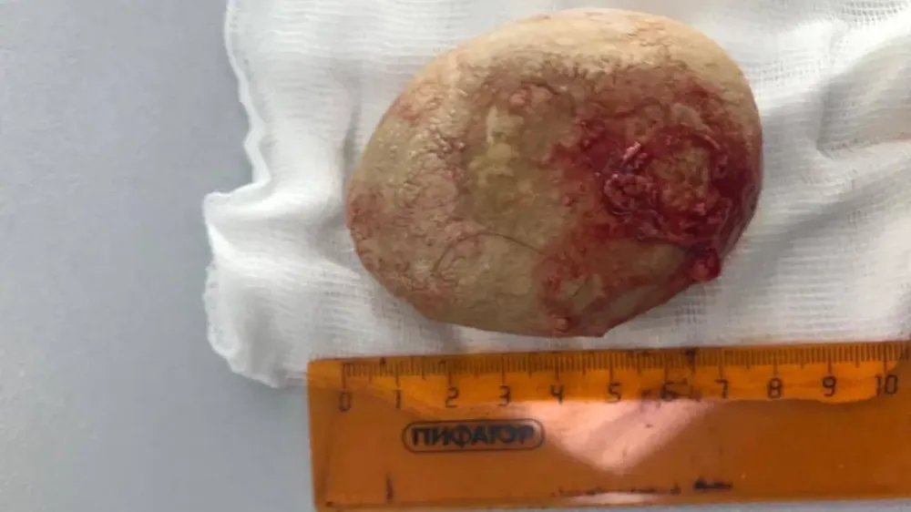 Медики из Щелково спасли пациента с гигантским камнем в мочевом пузыре