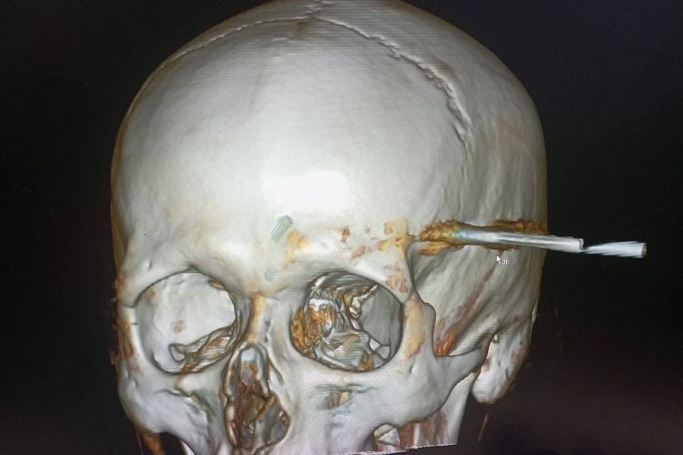 В Солнечногорске врачи спасли пациента с арбалетной стрелой в голове