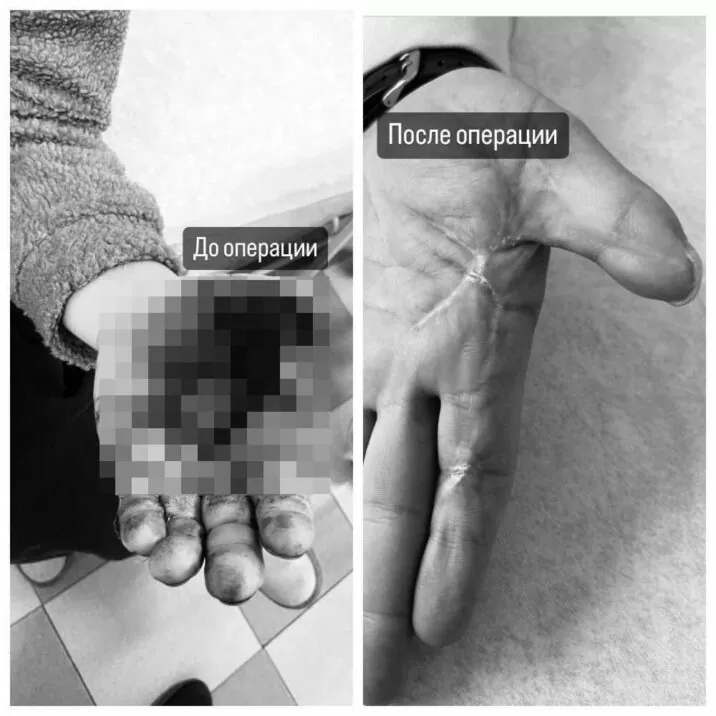 Травматологи из Мытищ сохранили функцию кисти руки у пострадавшего от взрыва петарды