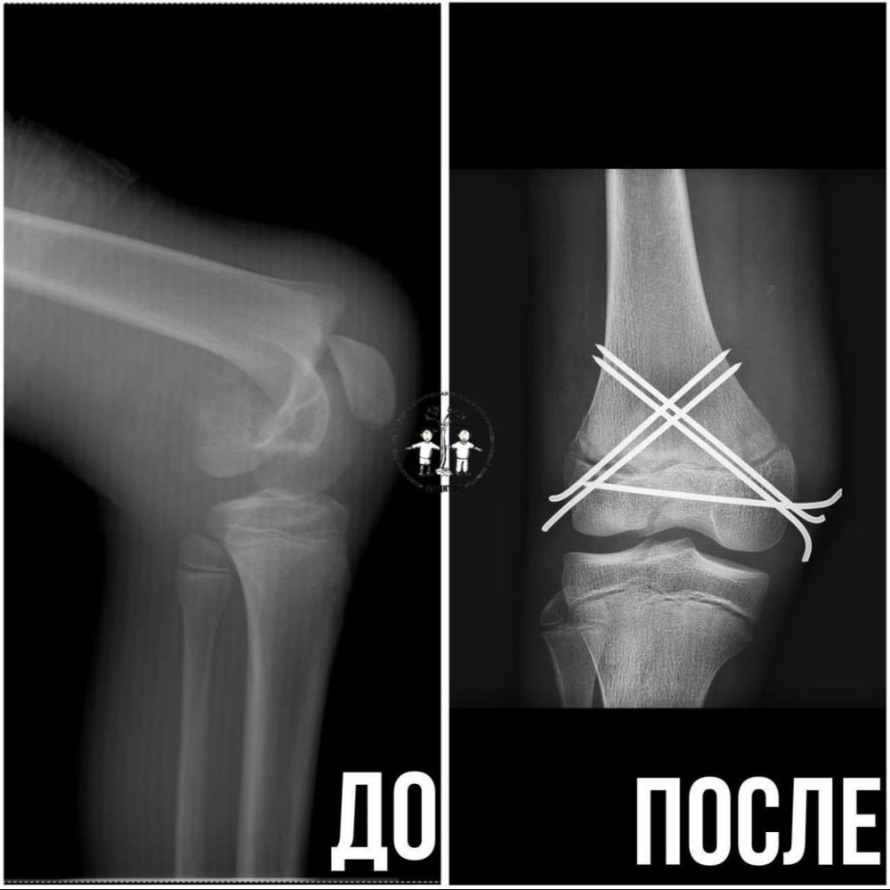 Врачи спасли ногу подростку