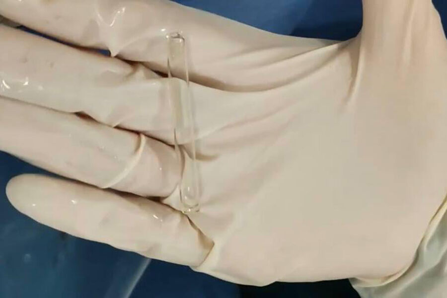 В Красногорске из мочевого пузыря мужчины извлекли пипетку