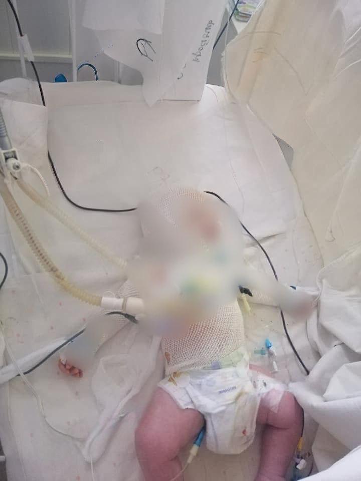 В Одинцово младенец опрокинул на себя чайник с кипятком