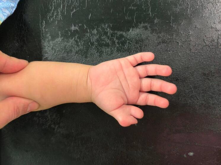 В Подмосковье врачи удалили лишний палец трехлетнему ребёнку