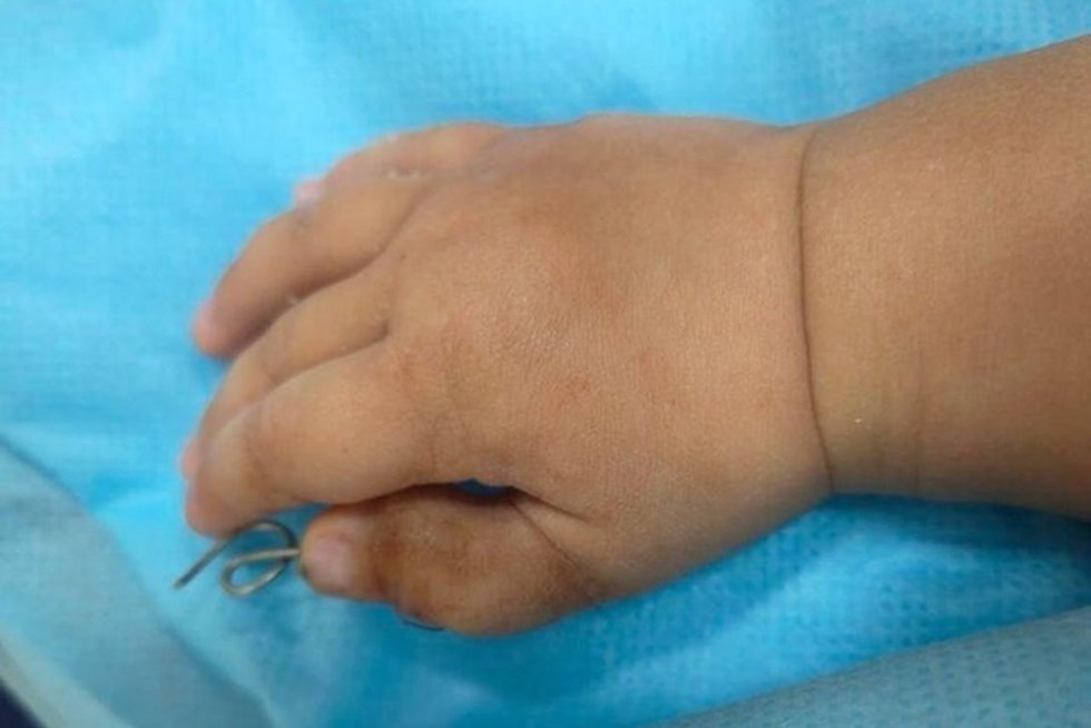 В Подмосковье врачи удалили лишний палец трехлетнему ребёнку