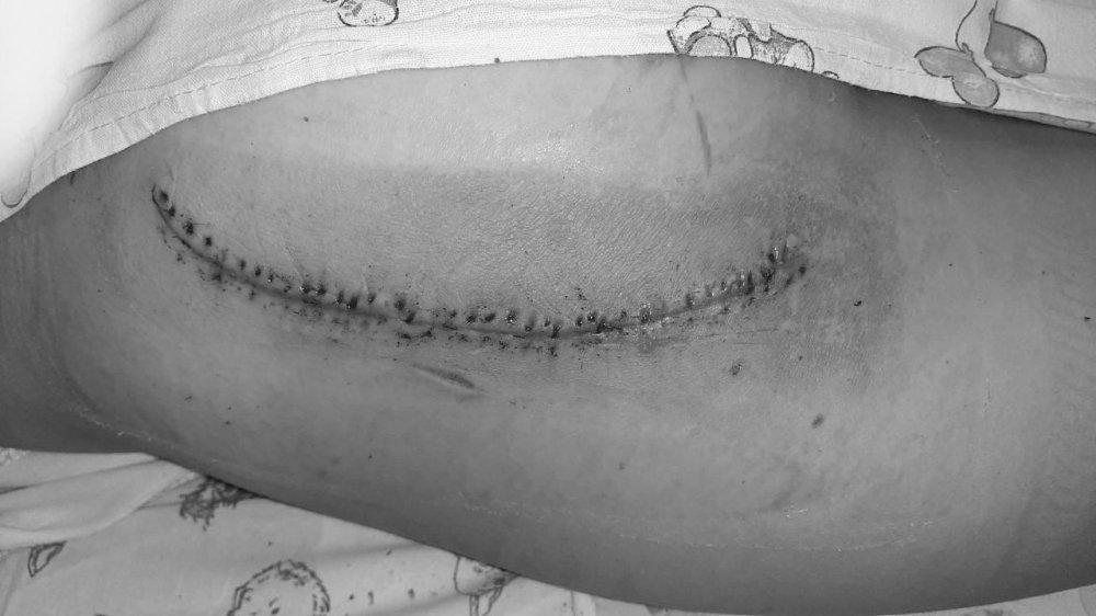 В Подмосковье спасли девочку с большой раной ягодицы