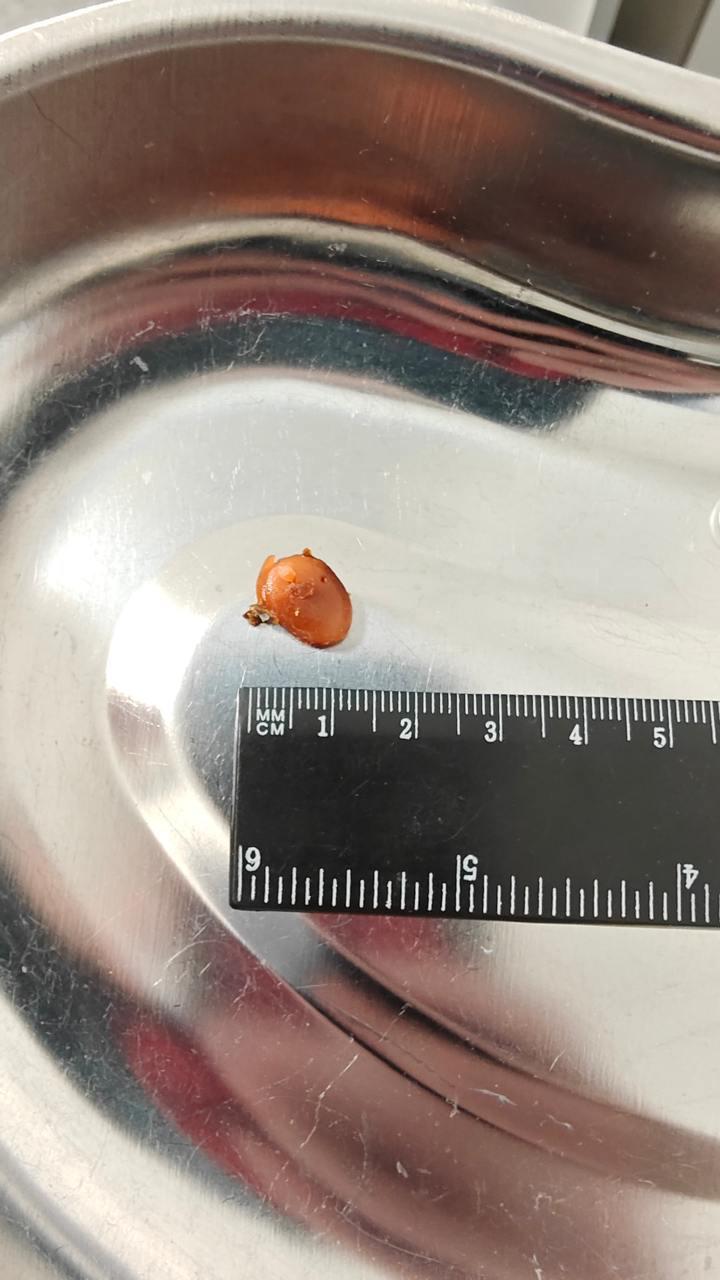 Житель Видного едва не потерял слух из-за берушей