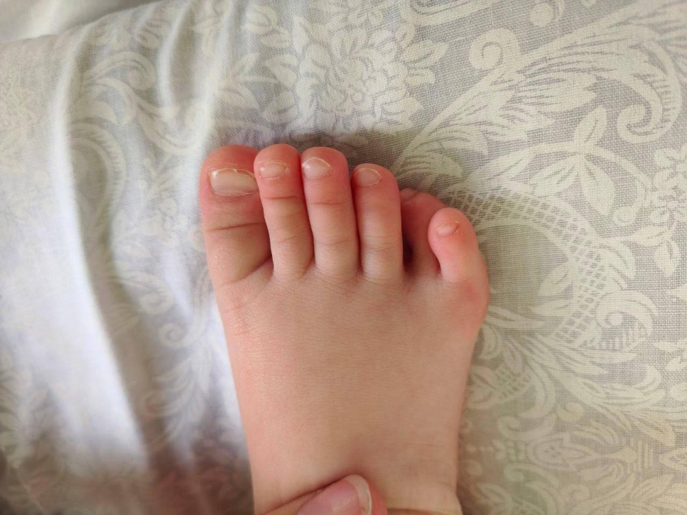 В Подмосковье хирурги успешно прооперировали ребенка с врожденной аномалией стоп