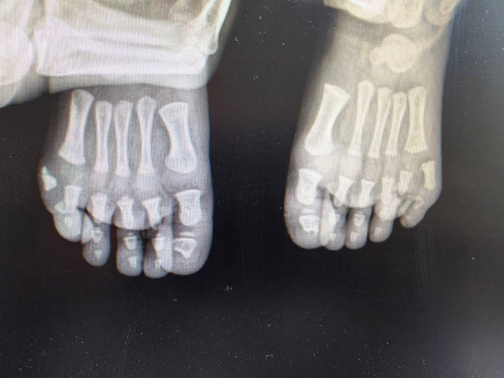 В Подмосковье хирурги успешно прооперировали ребенка с врожденной аномалией стоп